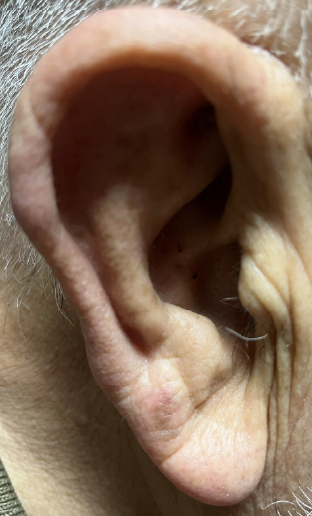 Ham kulak memesi görüntüsü